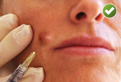 Steroid injections for keloids cost