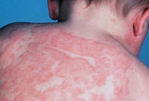 dermatitis i ekcemi