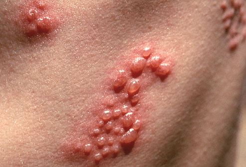 herpes