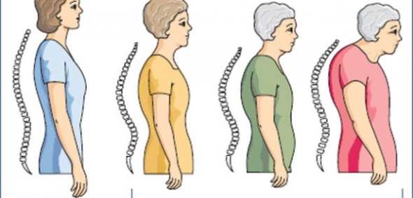 osteoporoza