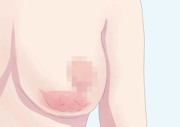 upala dojke mastitis
