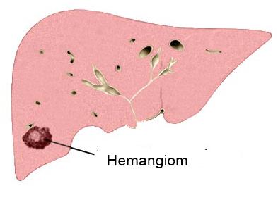 hemangiom na jetri