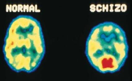 shizofrenija simptomi