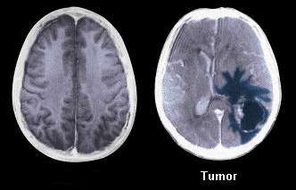 tumor mozga