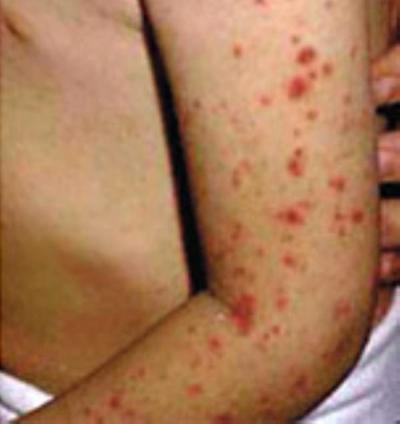 meningitis simptomi