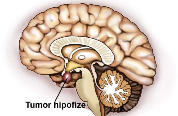 tumor na hipofizi