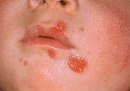 impetigo kod dece