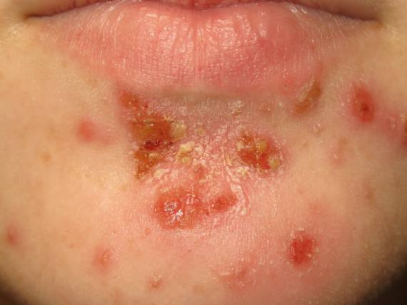 impetigo kod odraslih