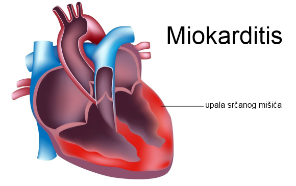 miokarditis upala srcanog misica