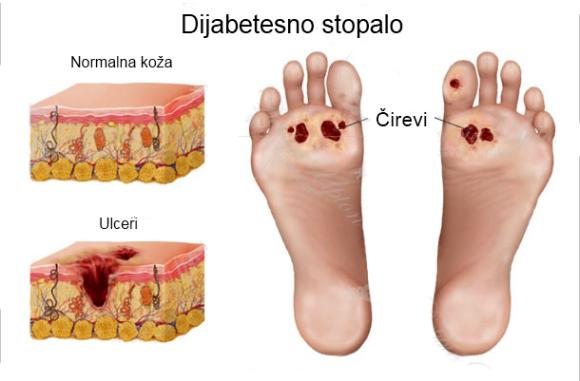 dijabetsko stopalao