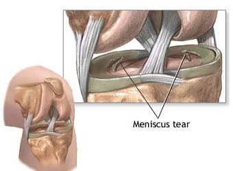 meniskus kolena