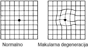 degeneracija makule