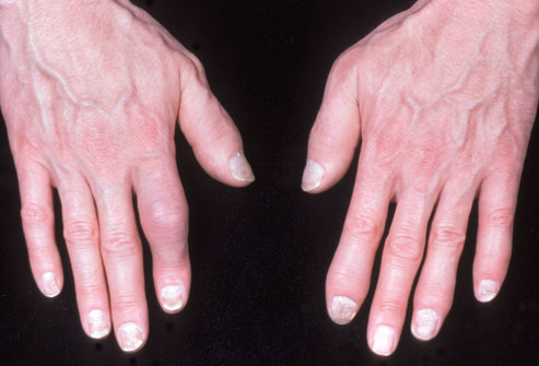 psorijaticni artritis