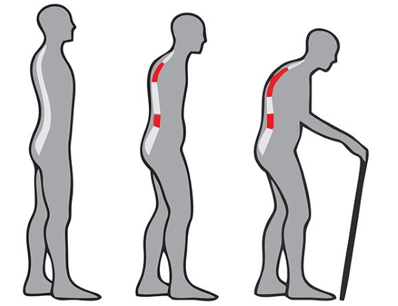 ankilozantni spondilitis