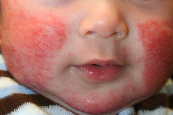 atopijski dermatitis