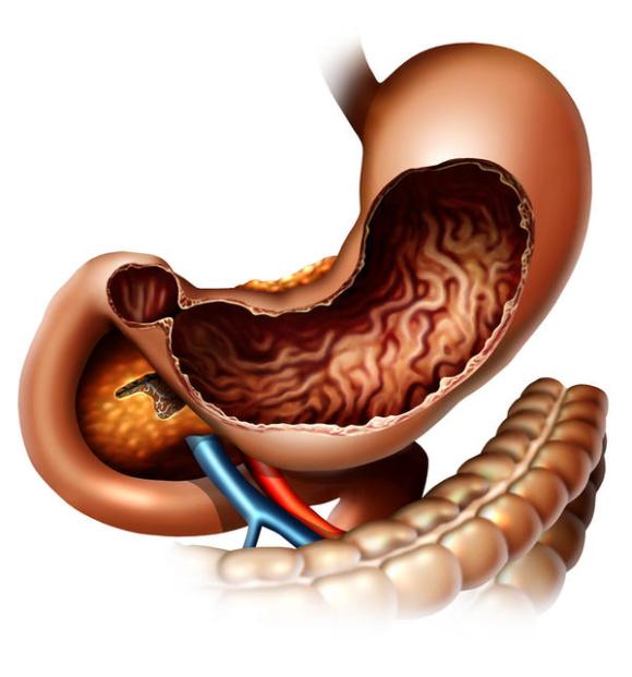 gastroparesis