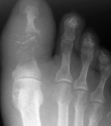 osteomijelitis