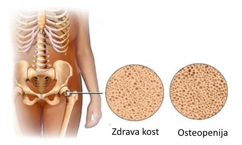 osteopenija ishrana