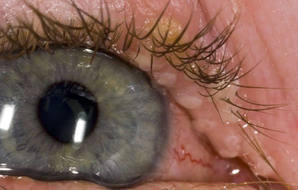 herpes na ocima