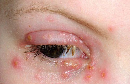 herpes na oku