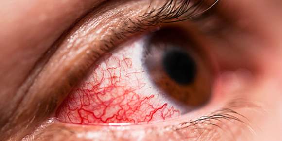 konjuktivitis