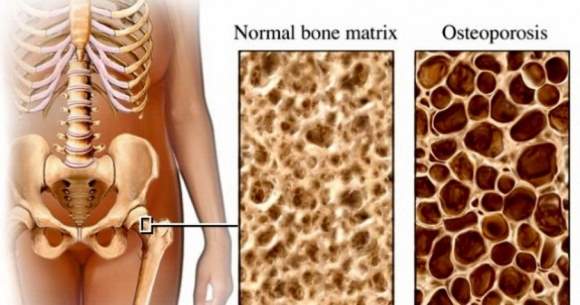osteoporoza