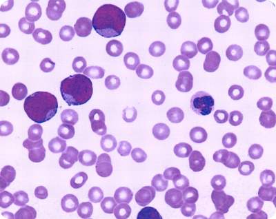 leukocitoza