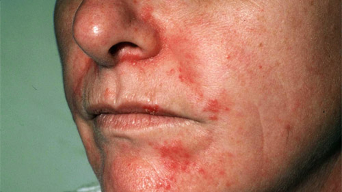 seboroicni dermatitis na licu