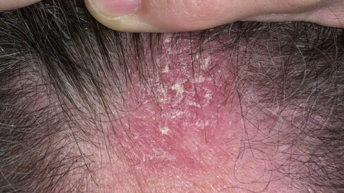 seboroicni dermatitis