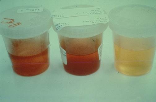 hemoglobin u mokraci
