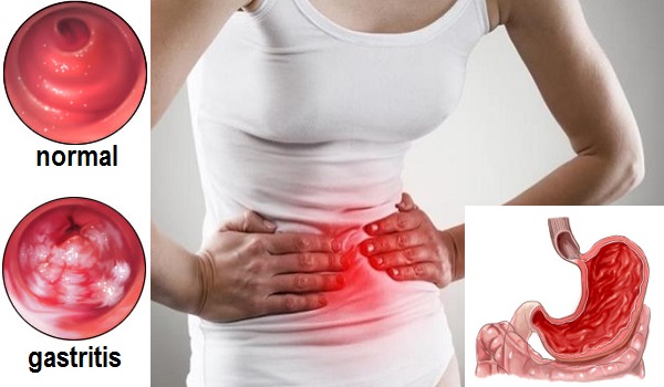gastritis simptomi