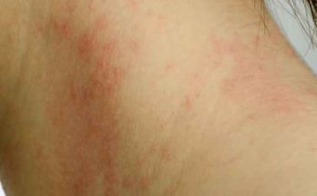 kontaktni dermatitis