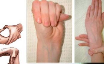 marfanov sindrom simptomi