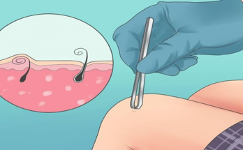 kako se resiti urasle dlake